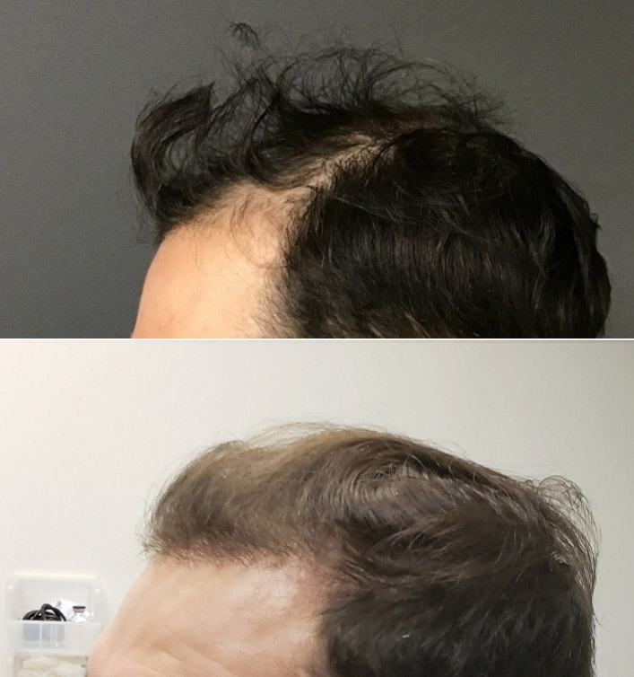 hair transplants Toronto Ontario