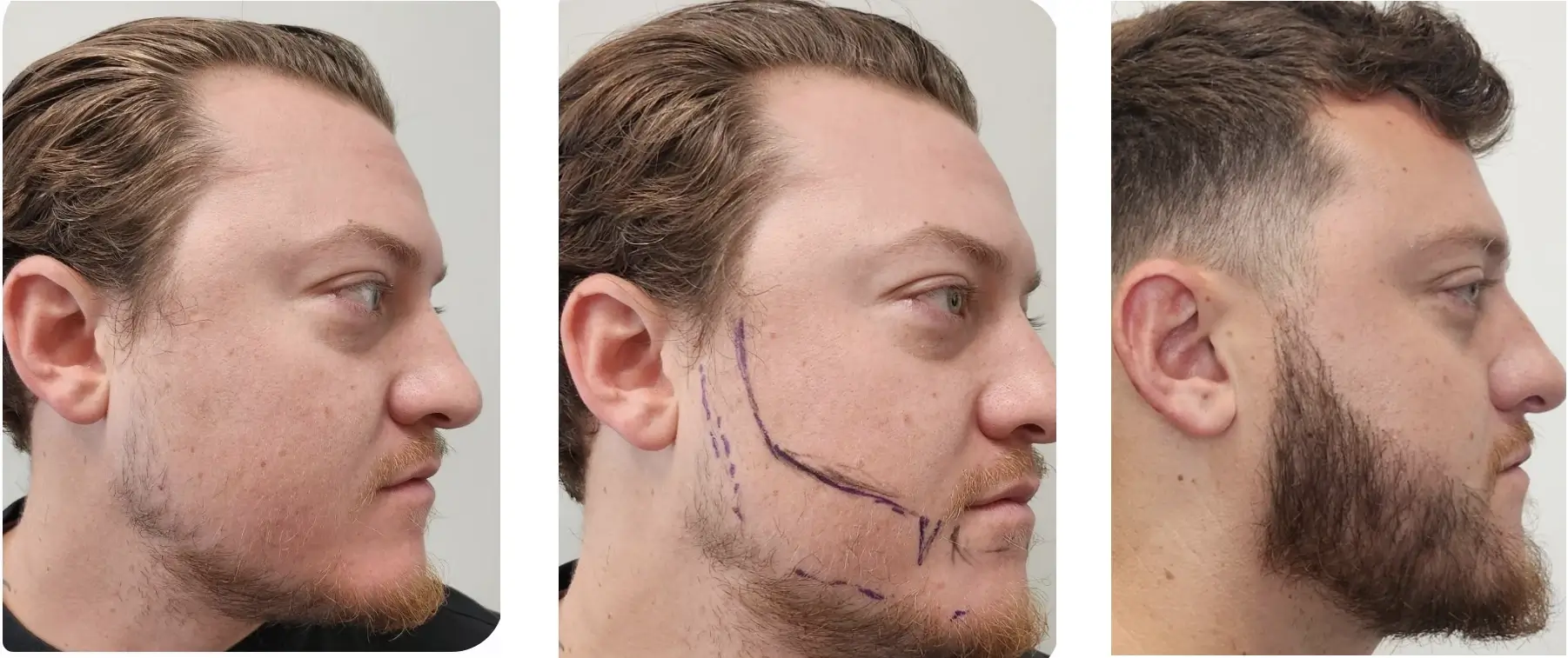 facial hair restoration buffalo ny