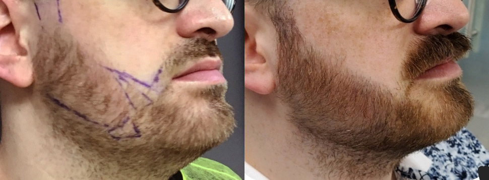 beard restoration buffalo ny