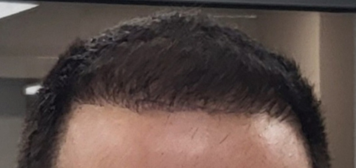 Patient 19 after hair restoration at HRA of Buffalo