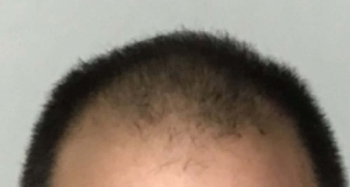 Patient 19 before hair restoration at HRA of Buffalo