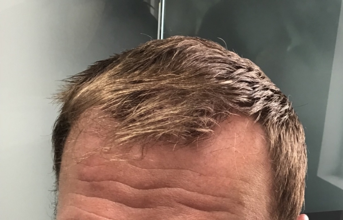 Patient 20 after hair restoration at HRA of Buffalo
