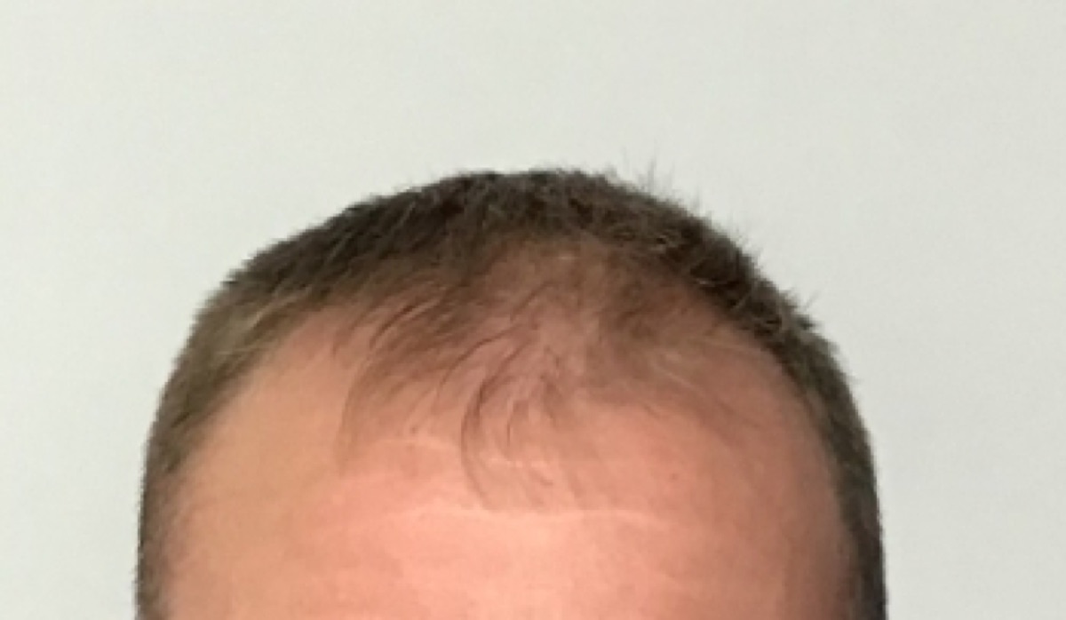 Patient 20 before hair restoration at HRA of Buffalo