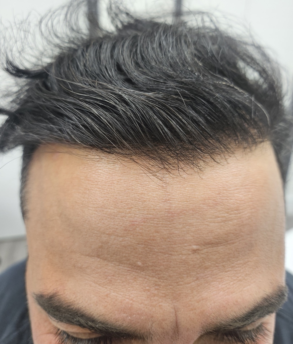 Patient 21 after hair restoration at HRA of Buffalo