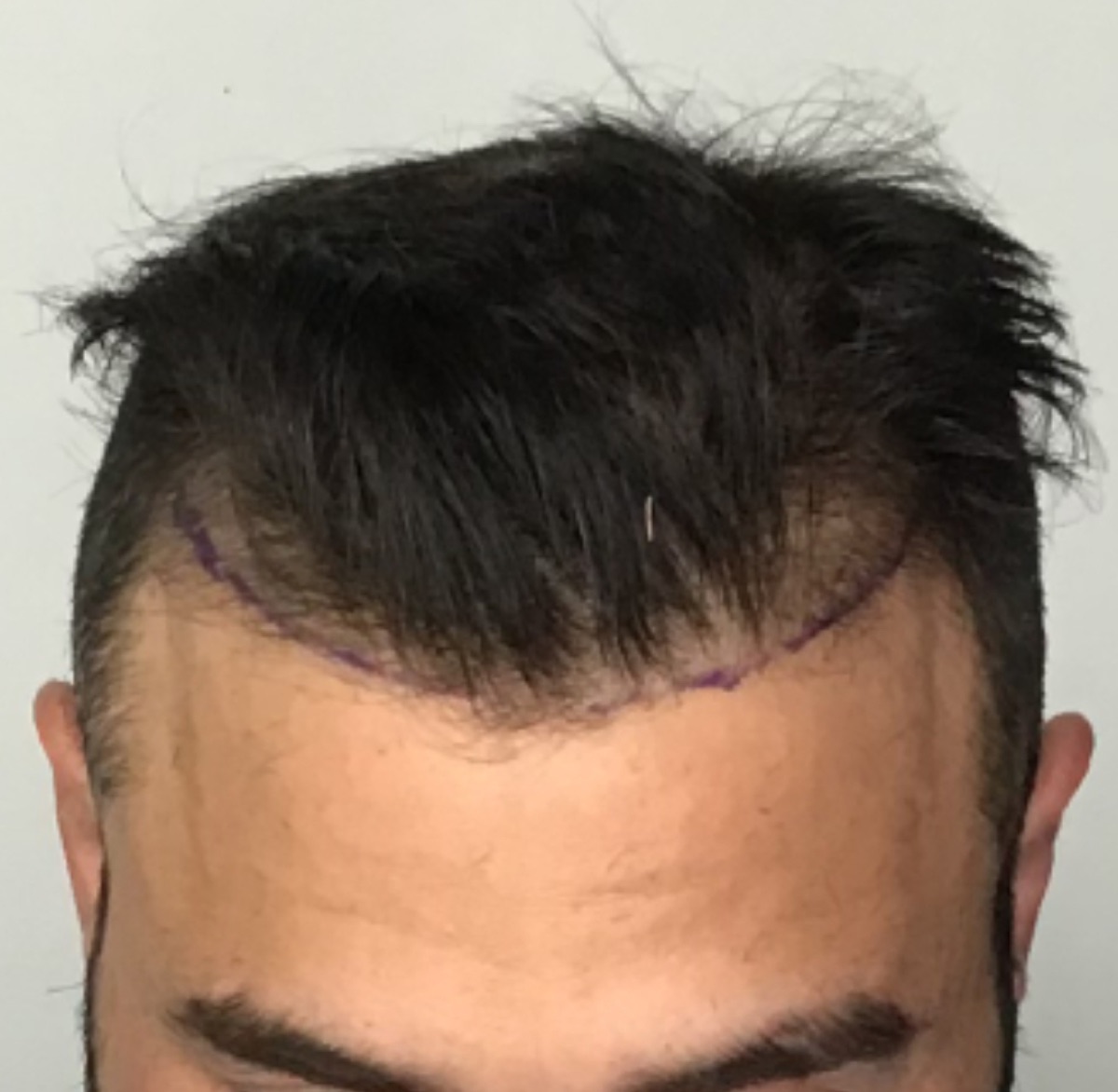 Patient 21 before hair restoration at HRA of Buffalo