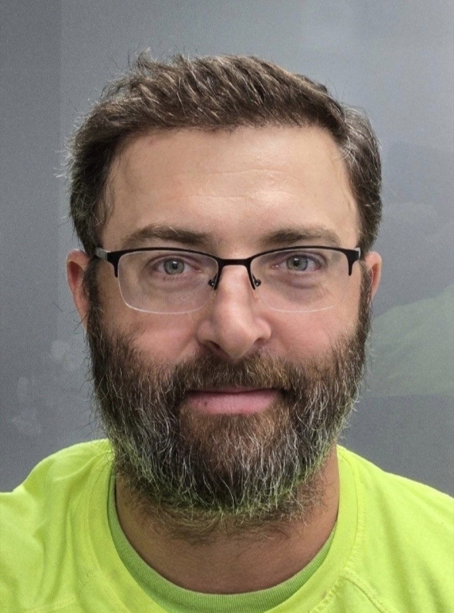 Patient 22 after hair restoration at HRA of Buffalo