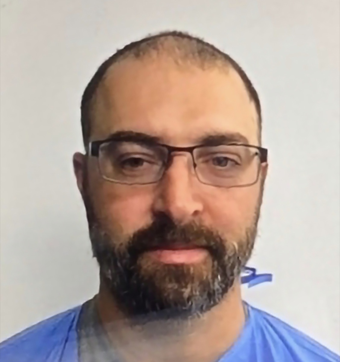 Patient 22 before hair restoration at HRA of Buffalo