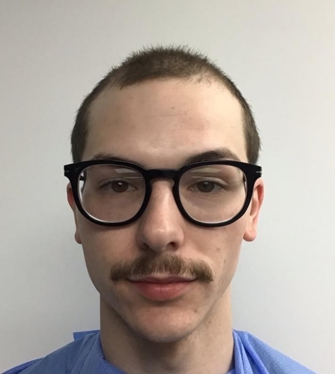 Patient 23 before hair restoration at HRA of Buffalo