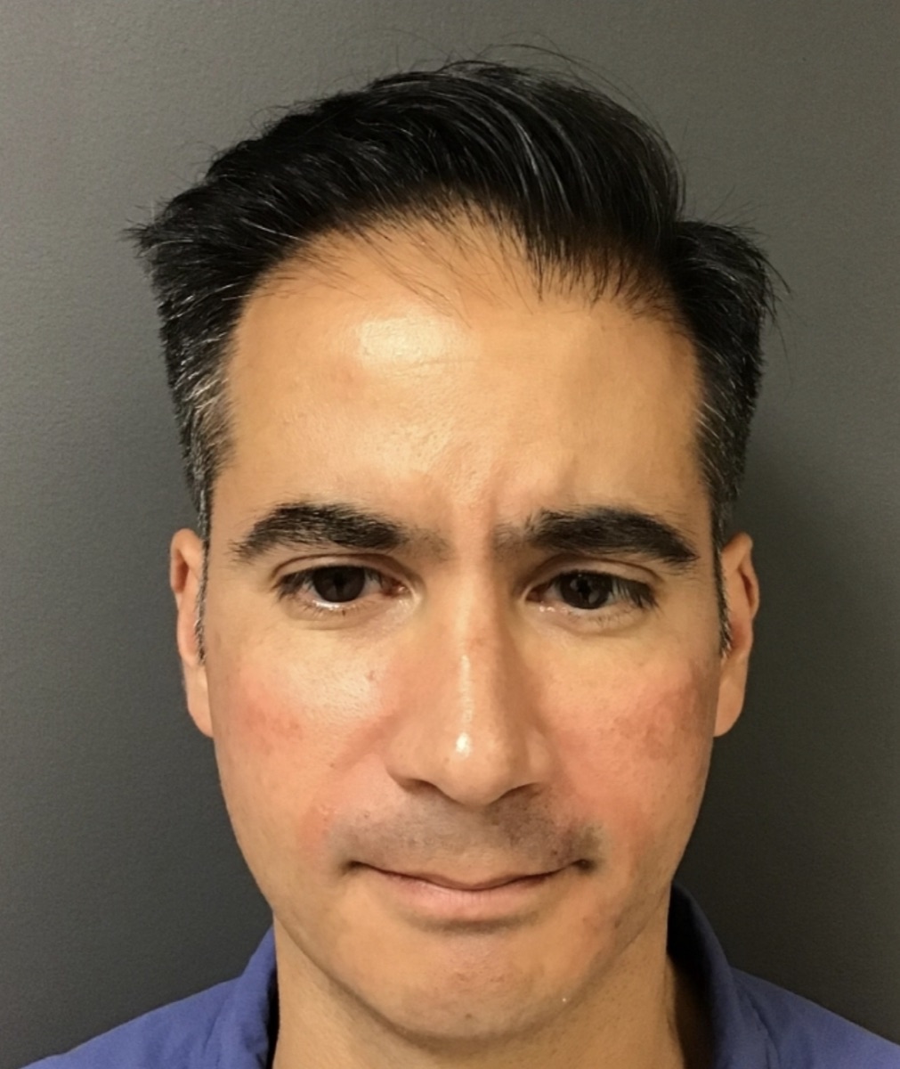Patient 24 before hair restoration at HRA of Buffalo