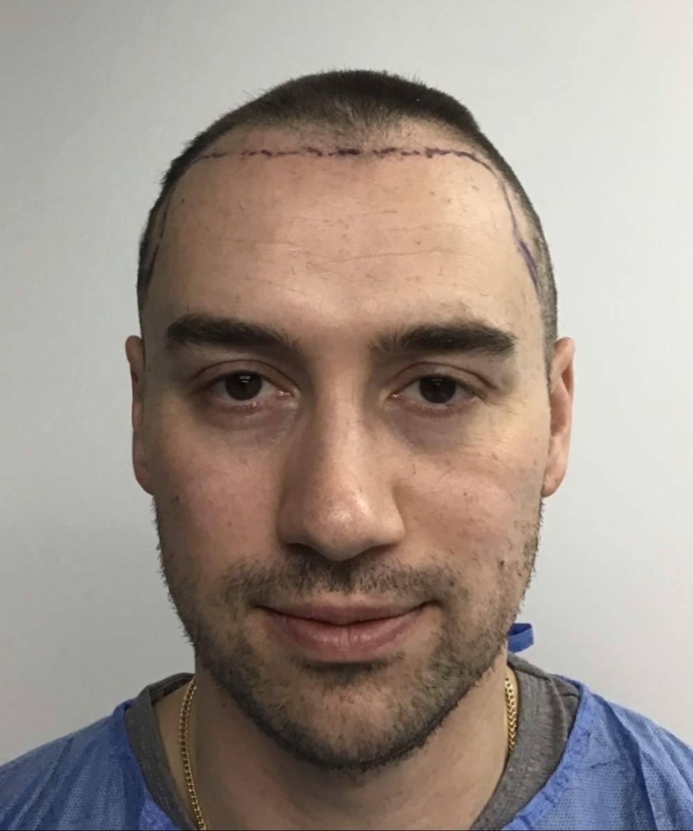 Patient 25 before hair restoration at HRA of Buffalo