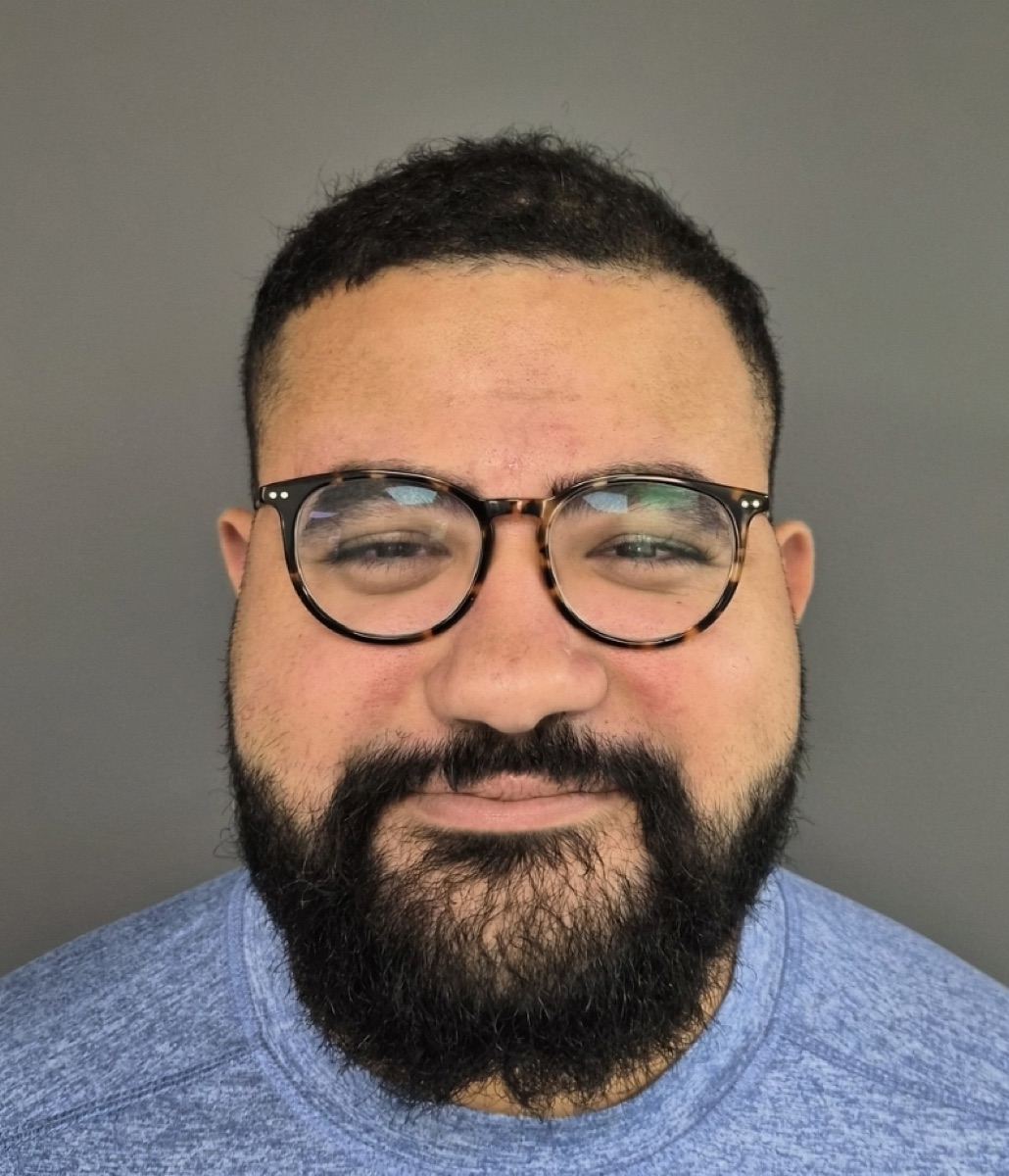 Patient 26 after hair restoration at HRA of Buffalo