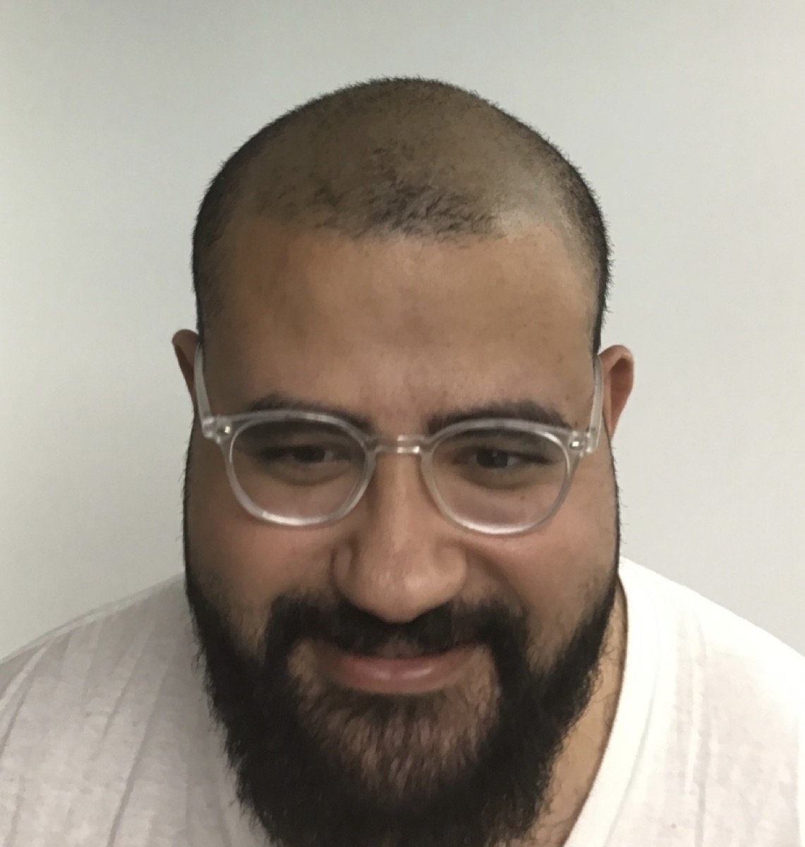 Patient 26 before hair restoration at HRA of Buffalo