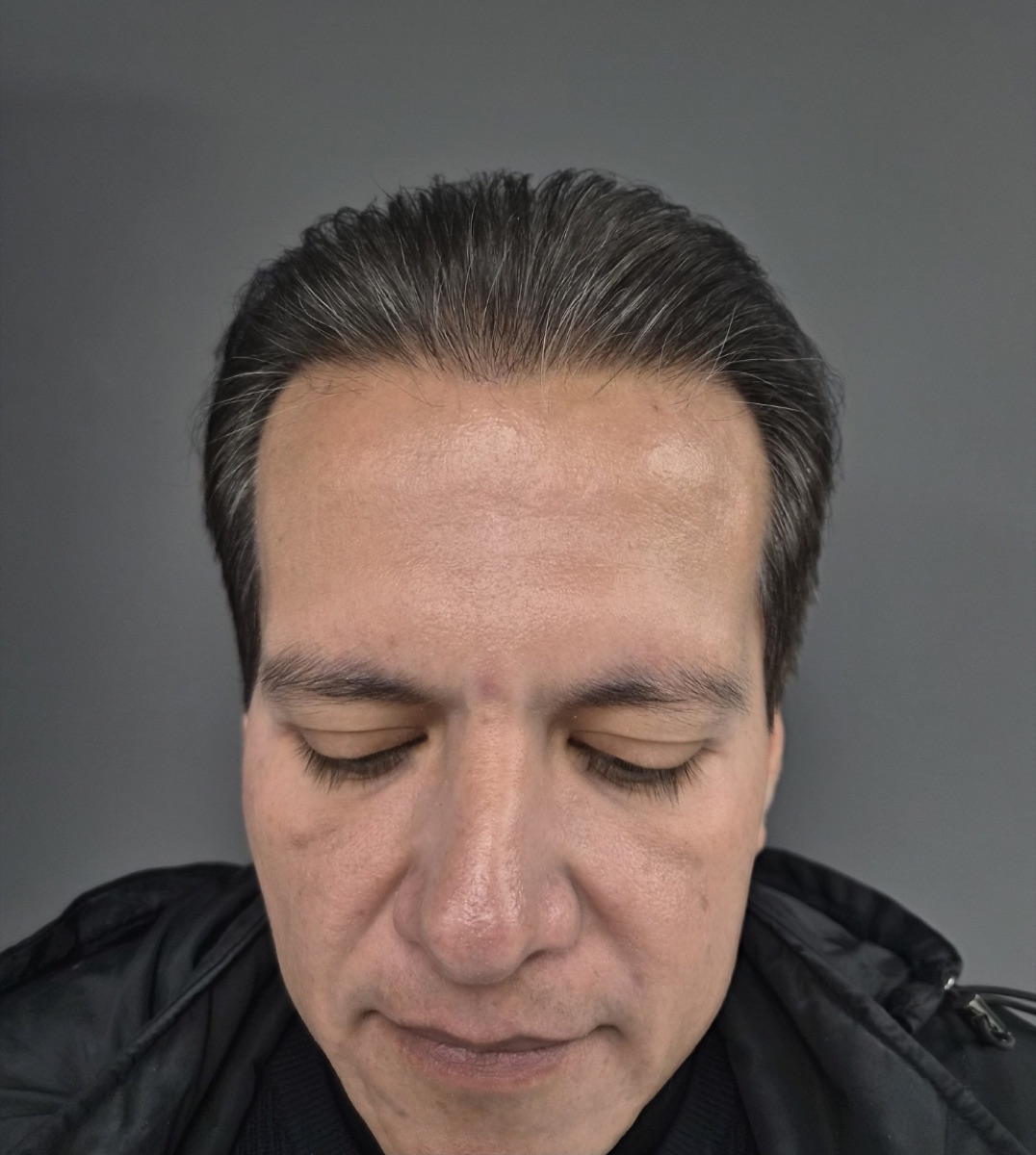 Patient 27 after hair restoration at HRA of Buffalo