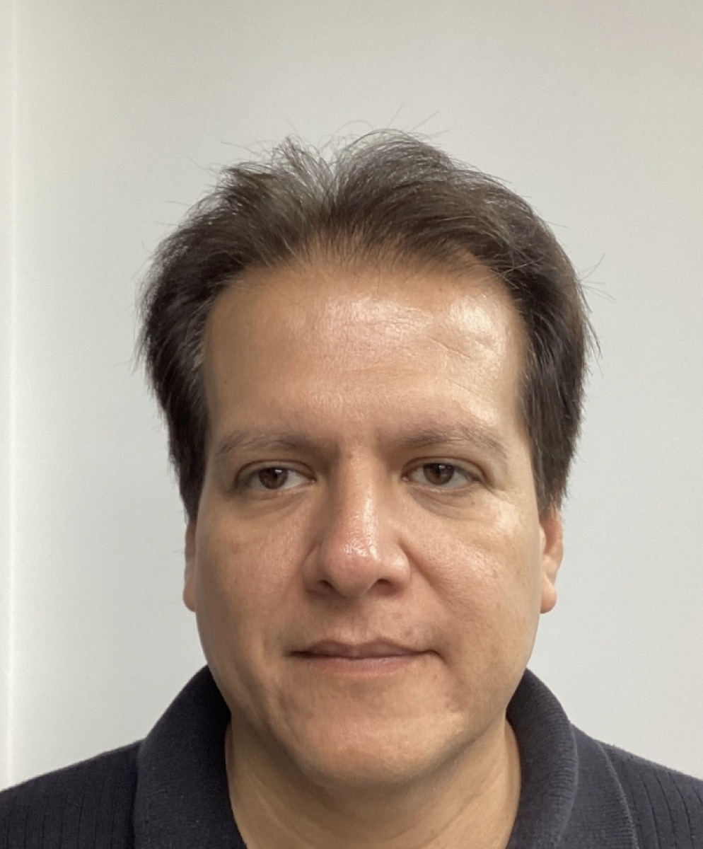Patient 27 before hair restoration at HRA of Buffalo