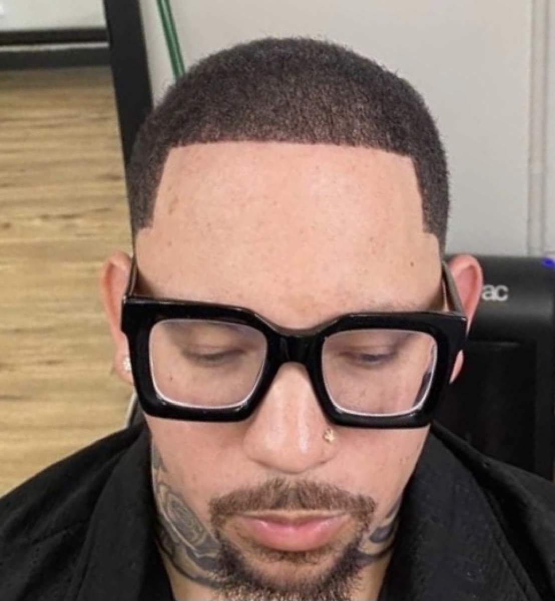 Patient 28 after hair restoration at HRA of Buffalo