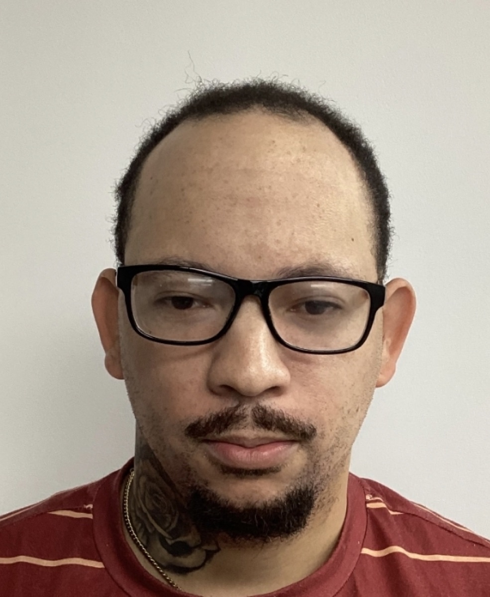Patient 28 before hair restoration at HRA of Buffalo