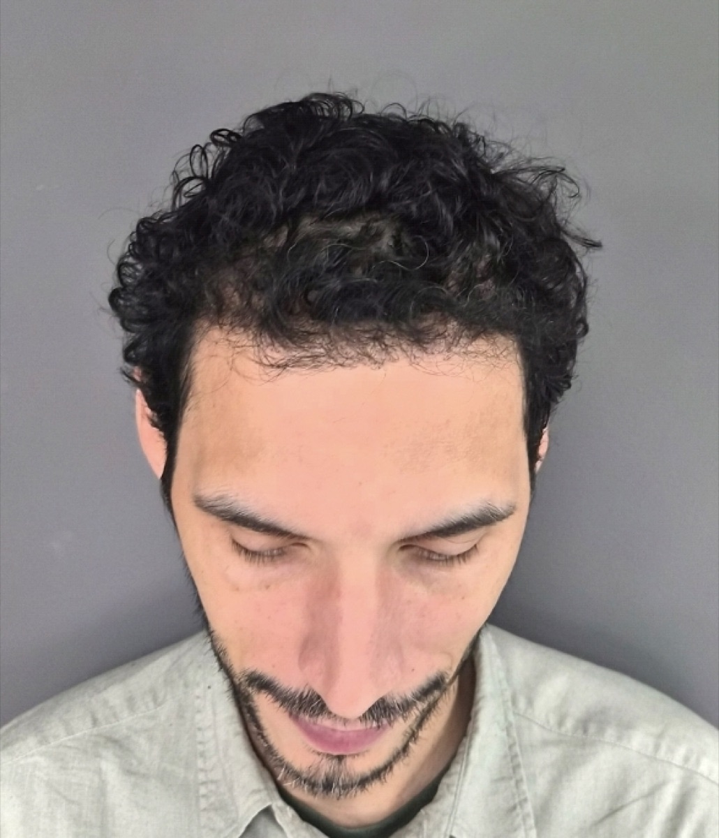 Patient 29 after hair restoration at HRA of Buffalo