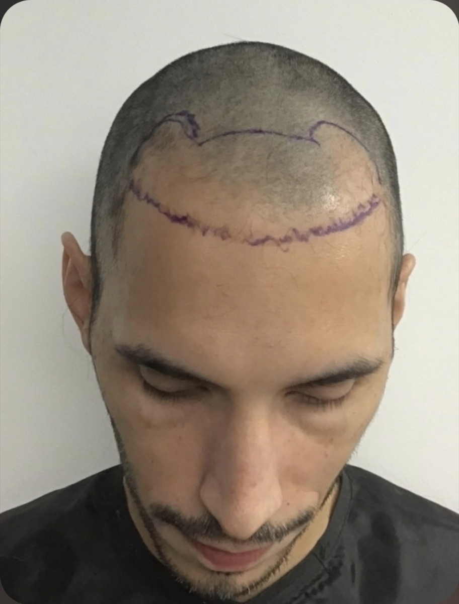 Patient 29 before hair restoration at HRA of Buffalo