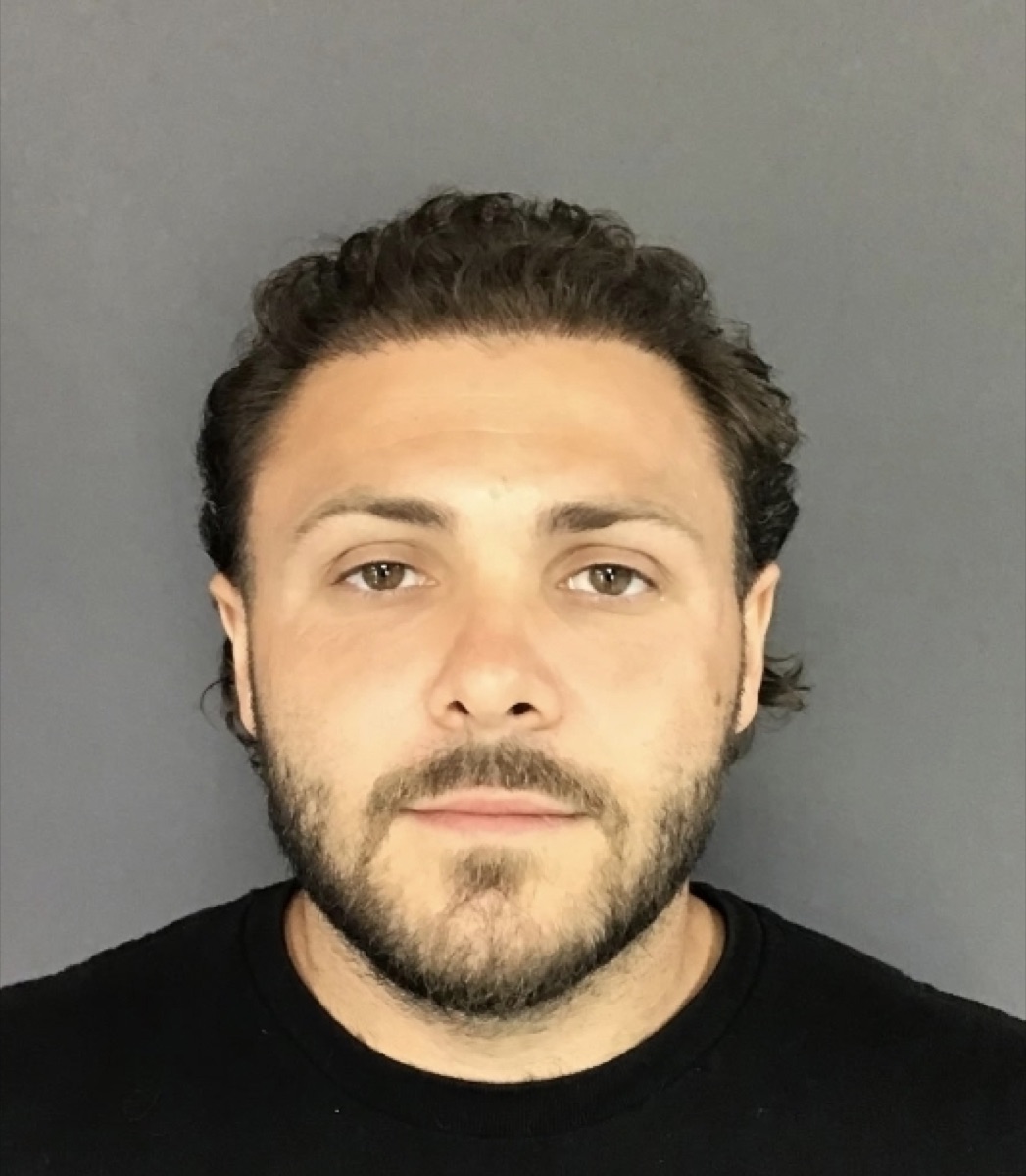 Patient 30 after hair restoration at HRA of Buffalo