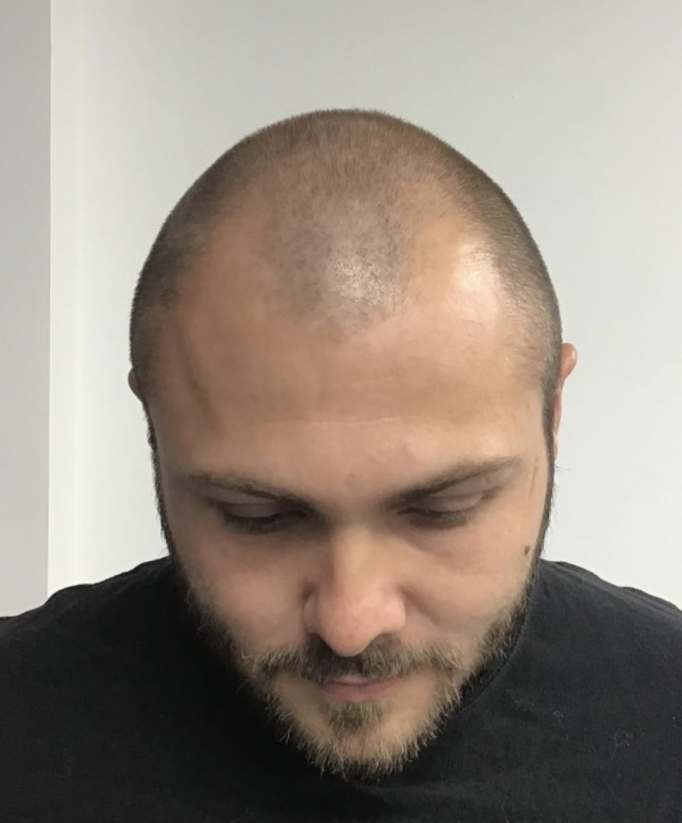 Patient 30 before hair restoration at HRA of Buffalo