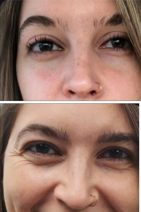 eyebrow scar revision