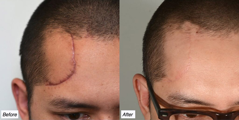 Scar Revision buffalo ny