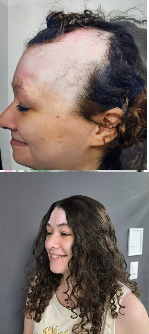 Scar Revision buffalo ny