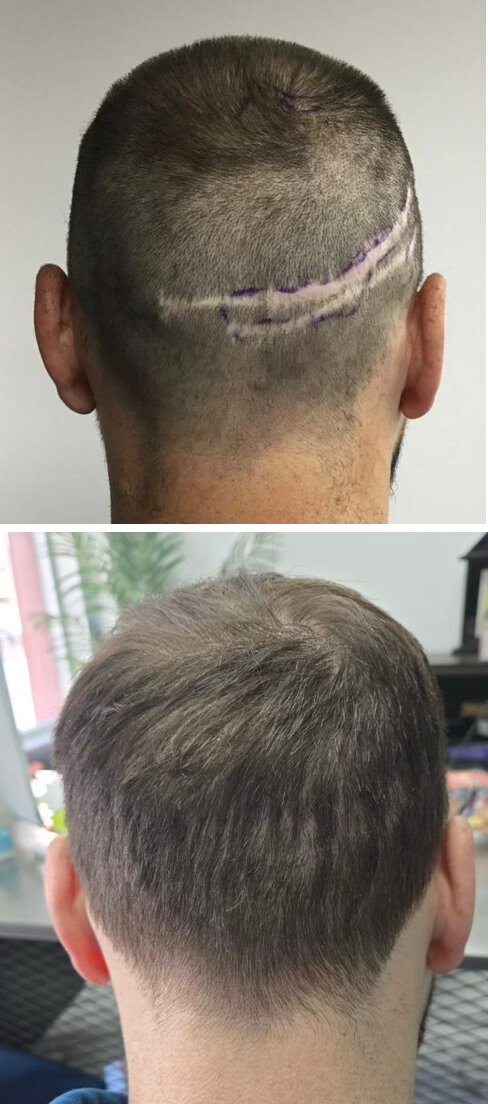 Scar Revision buffalo ny