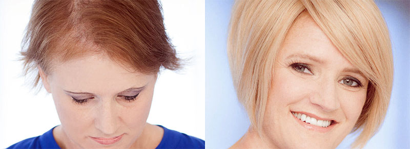 Hair Restoration for Women