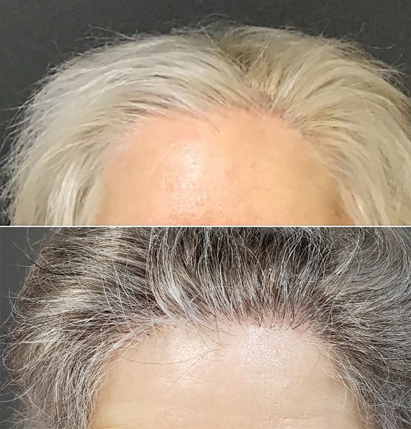 Scalp Hair Restoration for Women