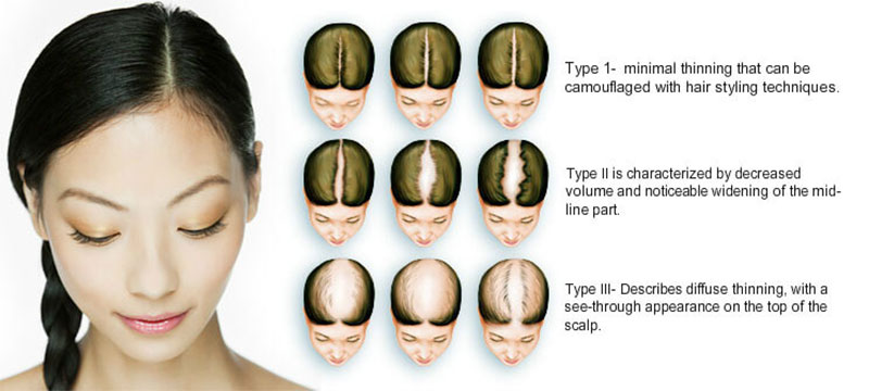 Scalp Hair Restoration