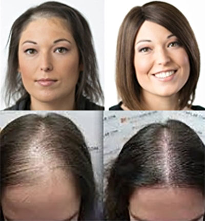 Scalp Restoration for Women